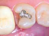 filling in tooth 45 Placement of
