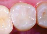 (Class II cavity) in tooth 25 1 2 3 4