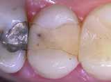 in tooth 25 Situation after removal of