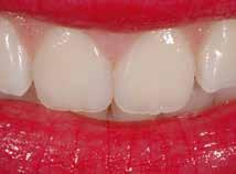 with natural teeth Anterior