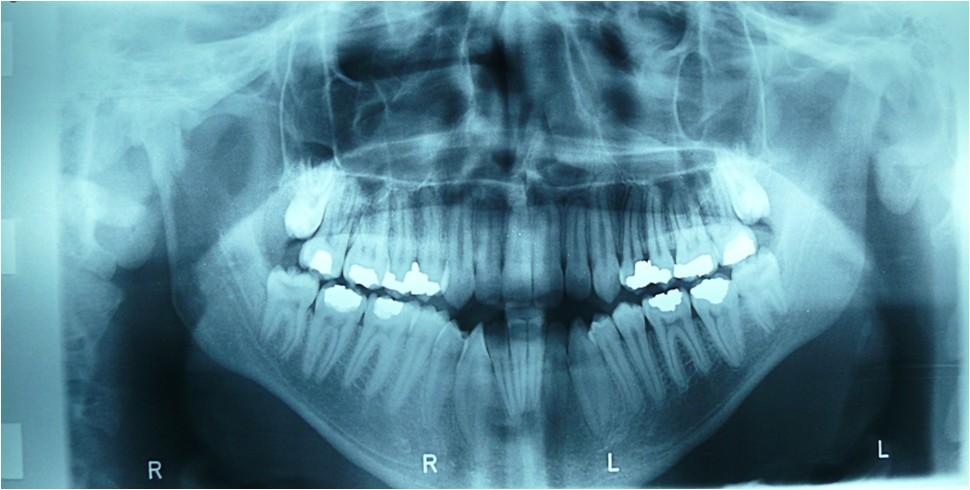 PERIAPICAL OR PANORAMIC RADIOGRAPHS BEFORE TREATMENT