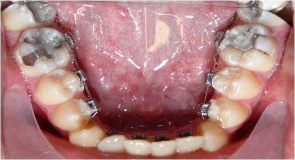 OCCLUSAL VIEW COLOUR PHOTOGRAPHS CANDIDATE