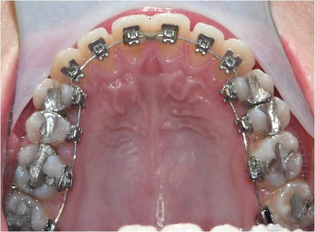 Occlusal Lower Occlusal TREATMENT STEPS INTRA-ORAL OCCLUSAL VIEW