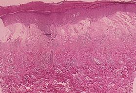 psoriasis, and localized pustular ps