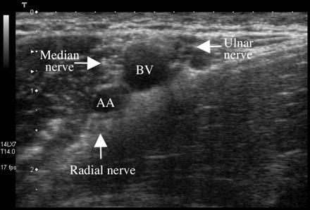 Nerve imaging with ultrasound Blokaad sonograafi kontrolli all Nerves are not
