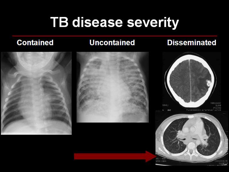 NON-SEVERE TB SEVERE TB