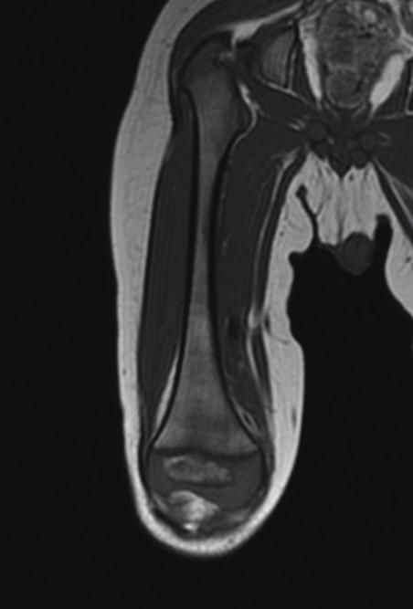 2 Case Reports in Radiology (a) (b) Figure 1: (a) Coronal T1-weighted image of the right femur shows hypointensity in the bone marrow of femoral diaphysis and epiphysis.