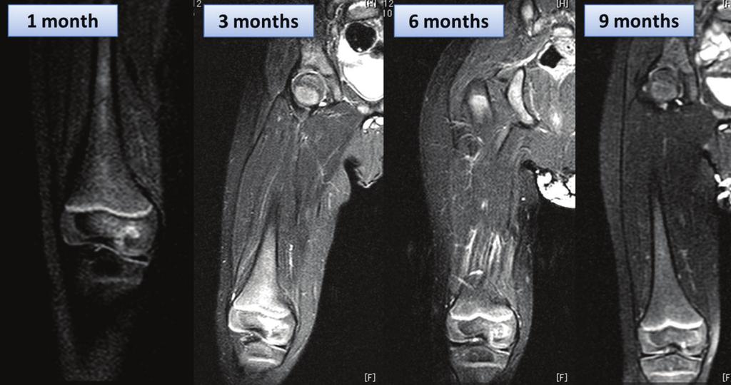 Two weeks after the intravenous antibiotics treatment, CRP was negative and MRI (Figure 2) showed improvement of abnormal intensity in the bone marrowofthefemurandtheadjacentsofttissue.