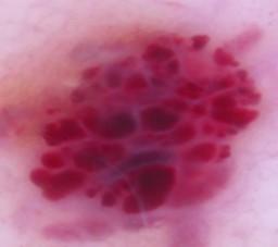 Melanocytic Mimickers: ngiomas Red/purple globules bsence of