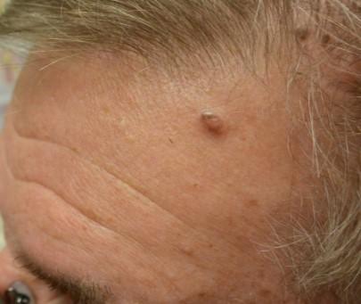 Question 2 55 year old man with an enlarging growth on his forehead Is there a pigment network/lines/streaks, aggregated globules, homogeneous?. B.