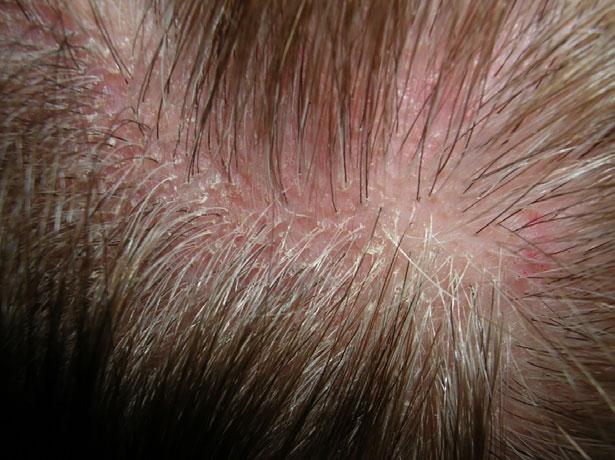 7% of our patients had lichen planuslike lesions in other body areas, mostly on the face and axillae.
