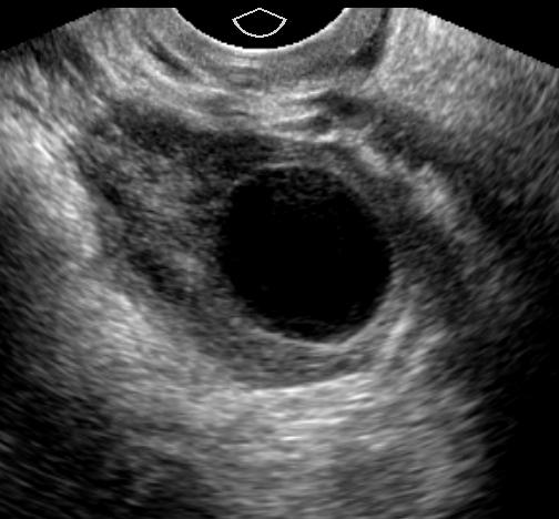 Ovarian Location Ovarian tissue extending