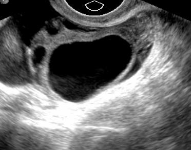 Ultrasound Criteria for a Simple Cyst Anechoic Imperceptible wall