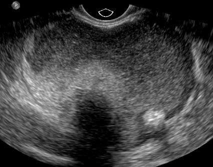 Ultrasound Appearance of Mature Cystic Teratoma Shadowing echogenicity