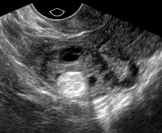 Mature Cystic Teratoma Focal or diffuse increased echogenicity