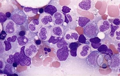 High Risk Myelodysplastic Syndrome with increased blasts