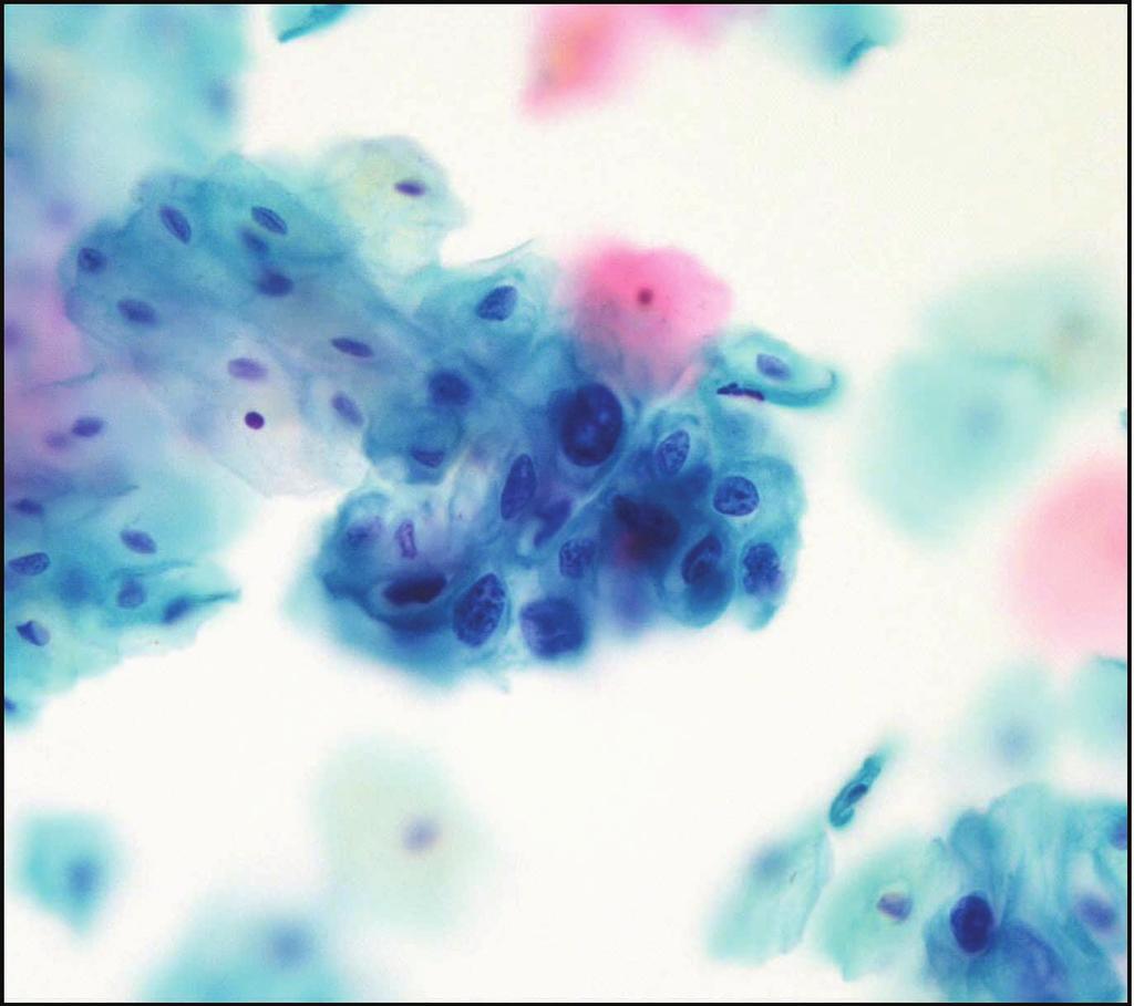 LSIL-H on Cervical Smear 531 A B C Fig. 1. Low-grade squamous intraepithelial lesion (LSIL), cannot exclude high-grade squamous intraepithelial lesion.