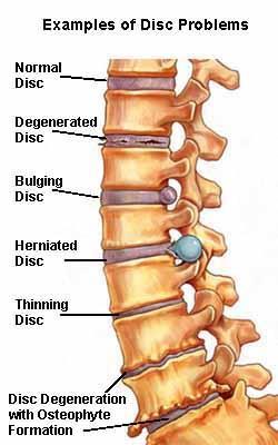 Cervical spondylosis: When the discs between the vertebra starts to degenerate, if this happens to the discs of the cervical vertebra pain occurs in the neck and the arms.
