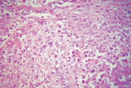 Uncommon pattern in soft tissues epithelioid sarcoma 231