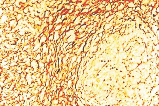 Eosinophilic cytoplasm of tumor cells (HE staining, ob.