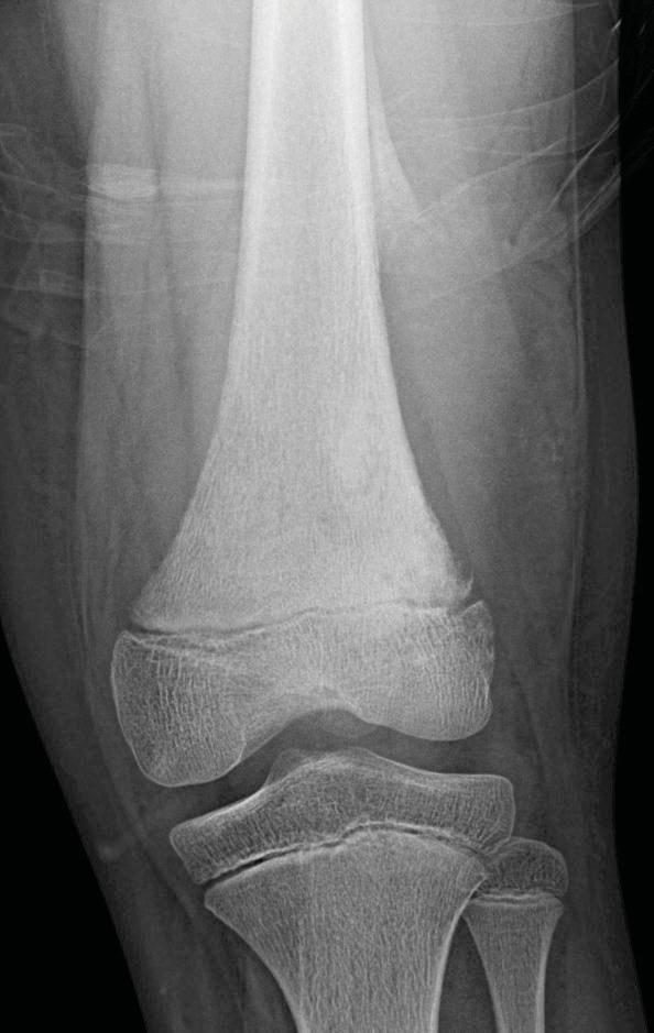 10 year-old boy with 1 month leg pain