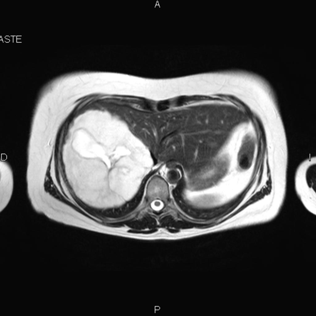Fig. 10: CASE 2. GIANT HEPATIC HEMANGIOMA. A 43-year-old woman was admitted to our hospital for right upper quadrant discomfort.