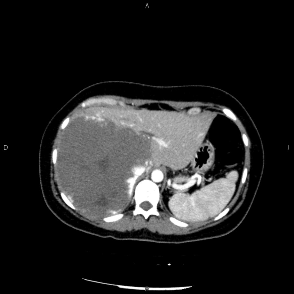 Fig. 16: Contrast-enhanced CT after embolization
