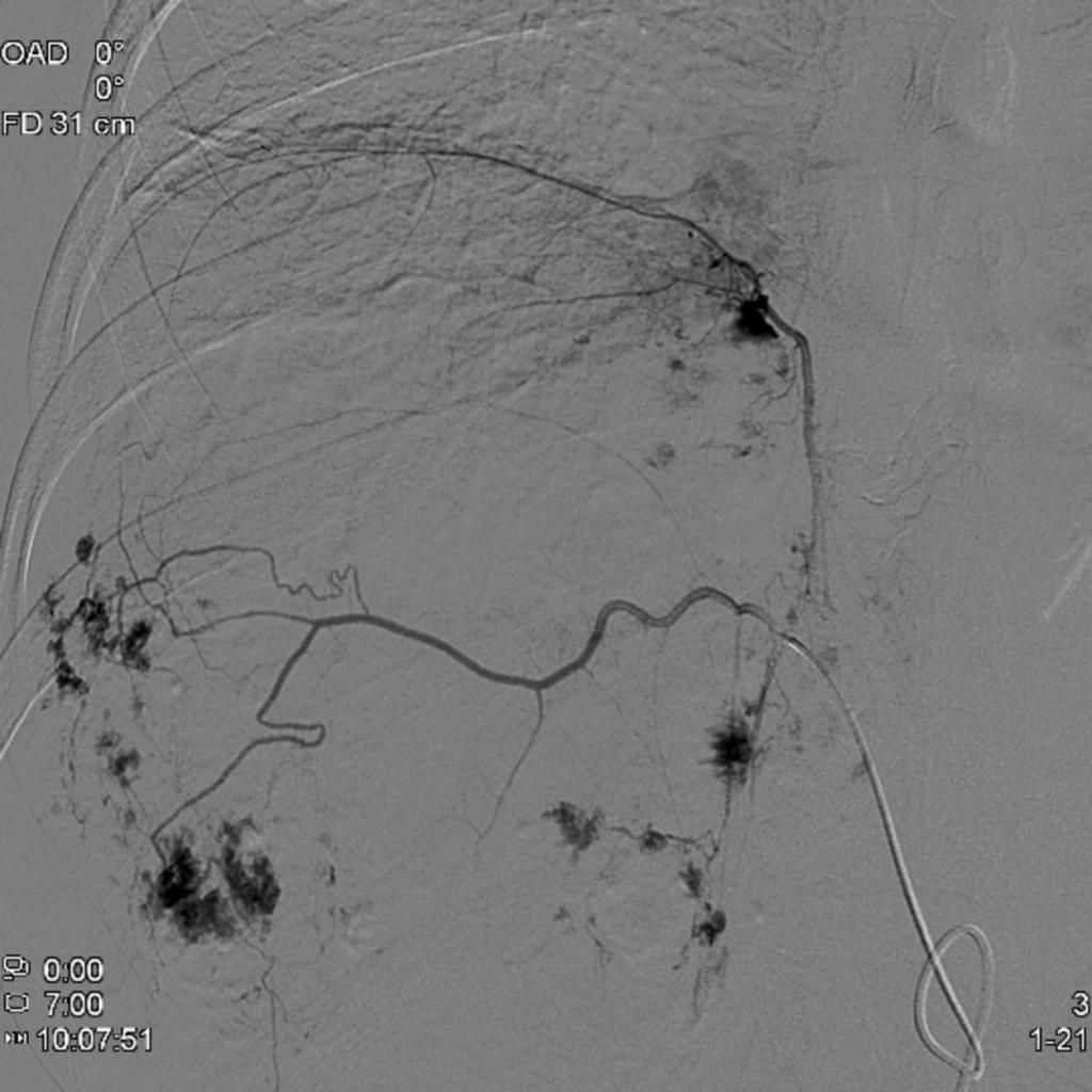 Fig. 19: We decided to perform intraarterial embolization using
