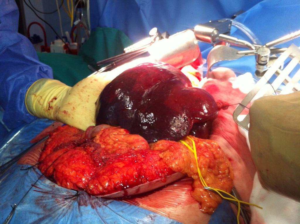 Fig. 20: Liver resection. The hemorrhage from the hepatic raw surfaces was minimal.