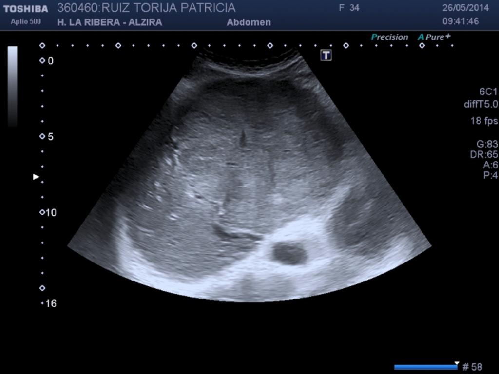 5 F 35 Abdominalleft lobe 11cm pain PVA CompleteADENOMA resection PVA CompleteADENOMA resection PVA Surgery ADENOMA pending Vomits 6 F 31 growing left lobe 8.