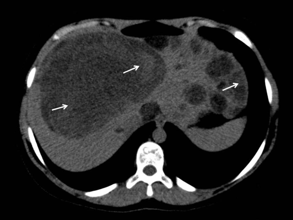 Fig. 25: Abdominal CT without contrast.