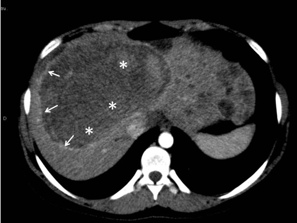 Fig. 26: Abdominal CT in arterial phase revealed variable enhancement of