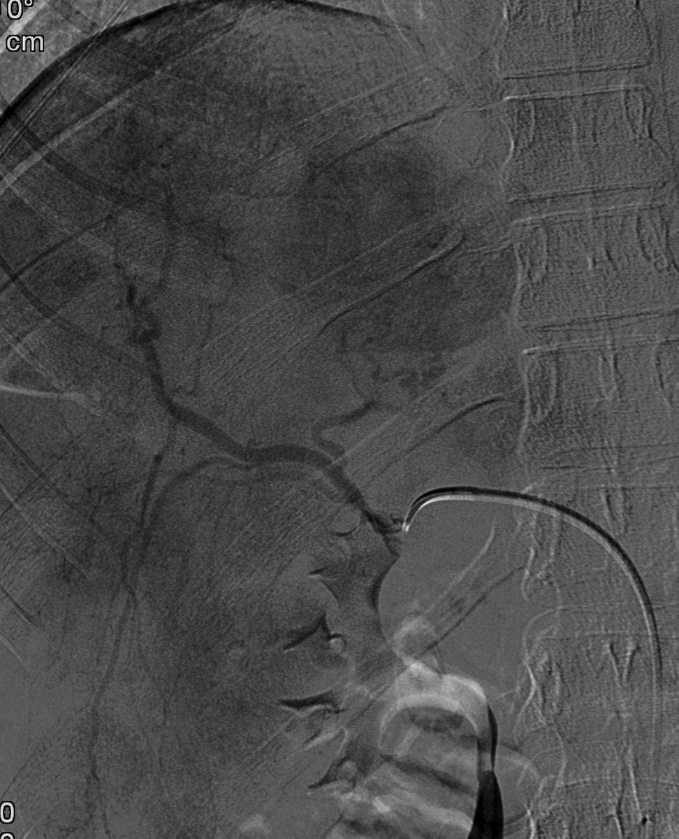 Fig. 27: Selective angiogram of the common hepatic artery showed the large adenomas in