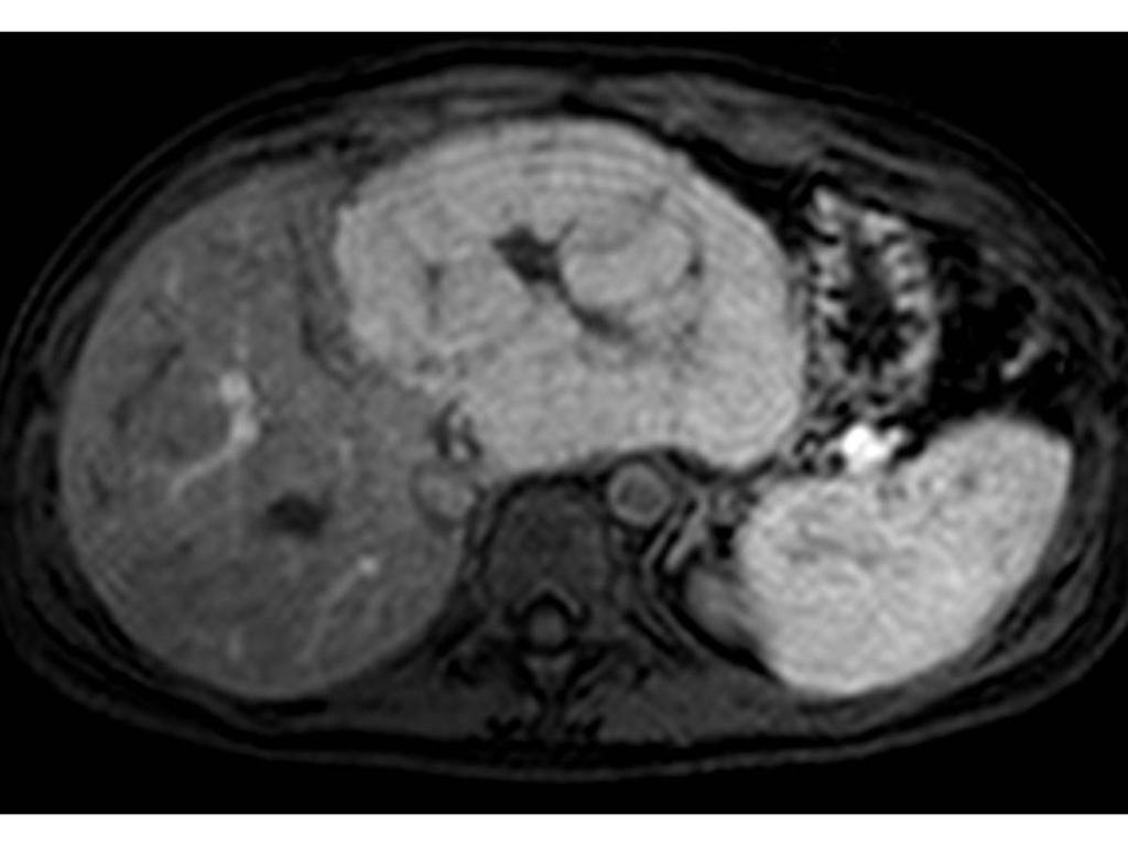 Fig. 2: Liver MRI with Gd-EOB-DTPA (Primovist (R)) in the arterial phase depicted a huge mass in the