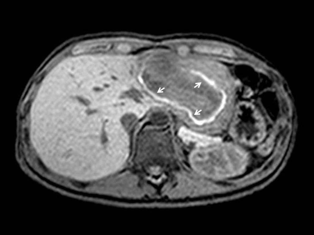 Fig. 38: CASE 5. ADENOMA. A 35 years old woman, with a history of ovarian stimulation for assisted reproductive treatment presented with abdominal pain and vomits.