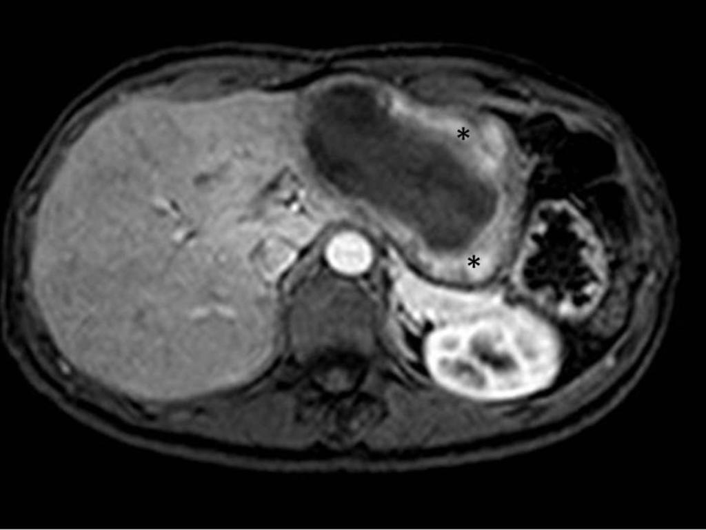 Fig. 39: Liver MRI with Gd in the arterial phase revealed intense enhancement of the
