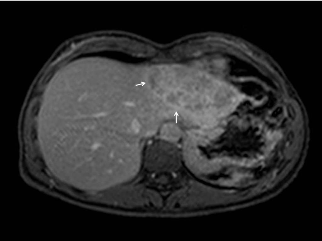 Fig. 41: Liver MRI in the equilibrium phase showing wash out of the