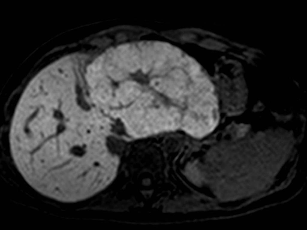 Fig. 3: Liver MRI with Gd-EOB-DTPA in the hepatocellular phase showed