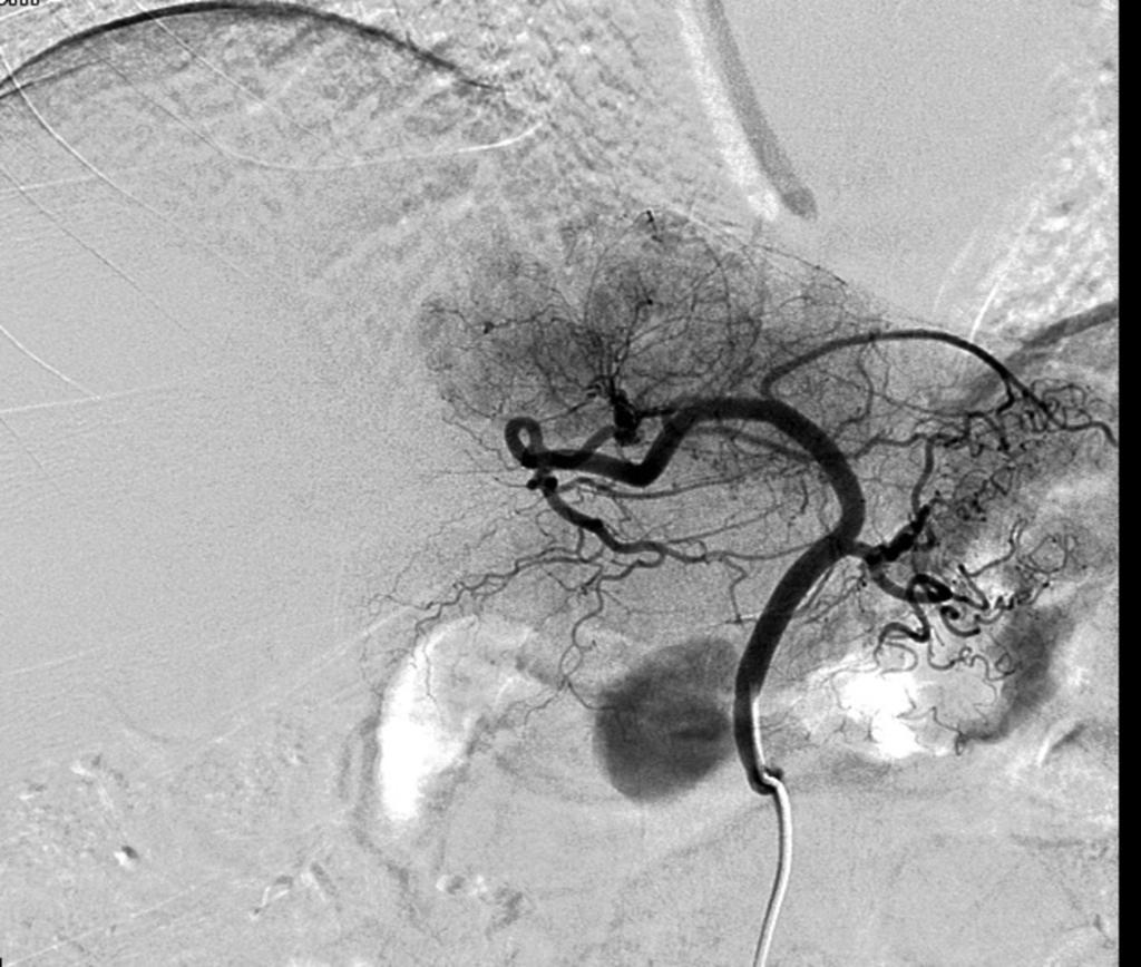 Fig. 47: Transarterial embolization previous surgery was performed. Patients had two left hepatic arteries.