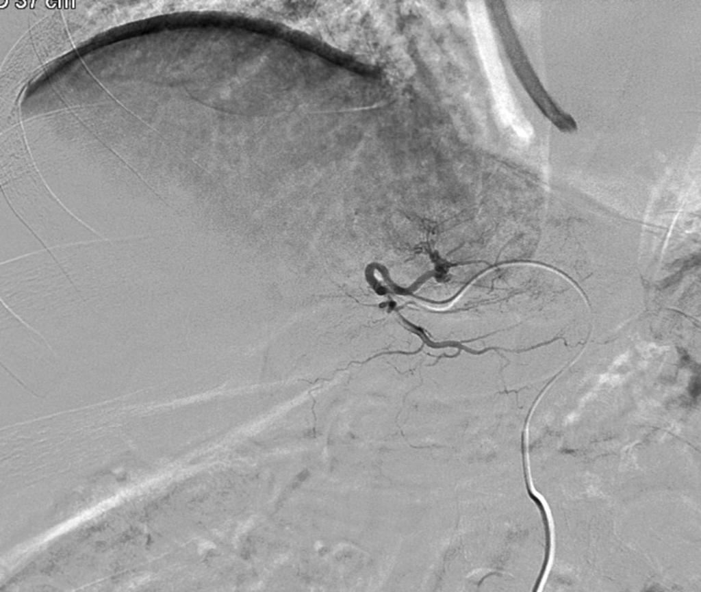 Fig. 49: Left hepatic artery completely occluded using PVA particles (300-500 mc).