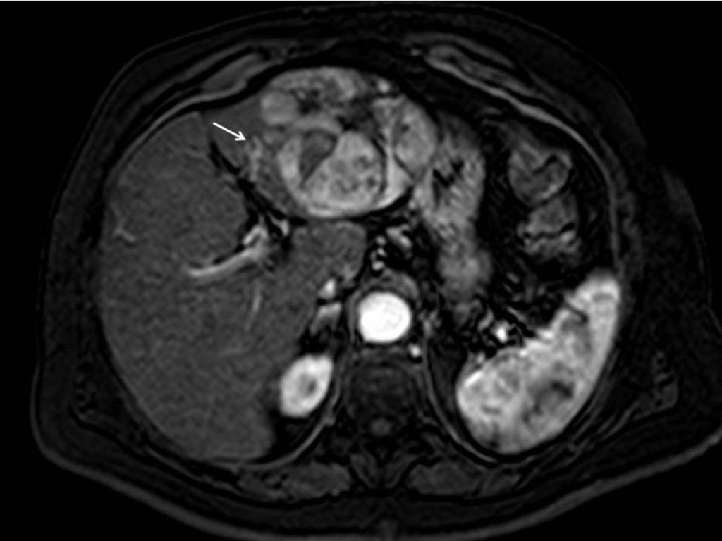 Fig. 52: CASE 7. ADENOMA. A 74 years old woman was referred to the radiology department for abdominal pain, nausea and vomits.