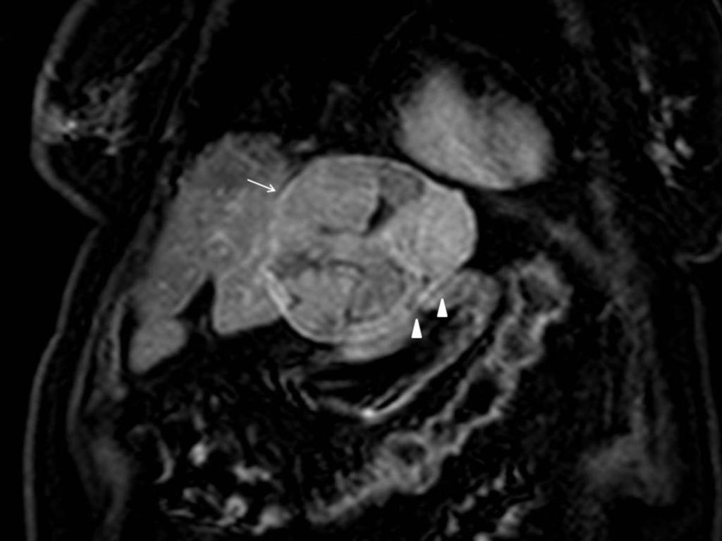 Fig. 53: Liver MRI in the equilibrium phase depicted the pseudocapsule formation
