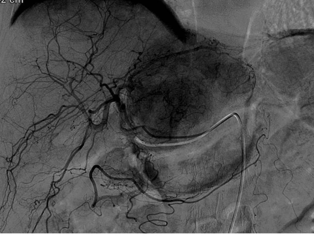 Fig. 54: Selective angiogram showed a hypervascularized mass in
