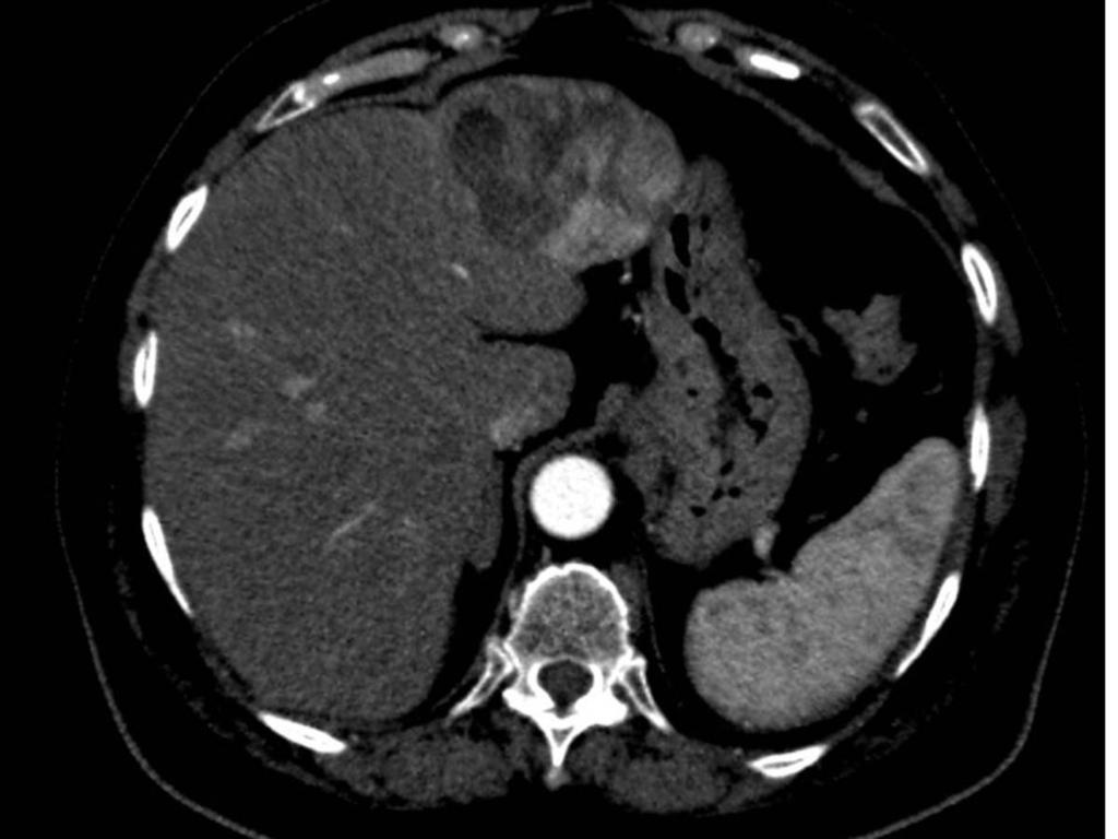 Fig. 55: CT 1 month after embolization showed significant decrease in size and absence of gastric