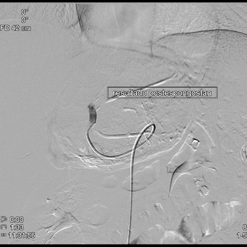 Fig. 6: Angiogram obtained before embolization with gelfoam