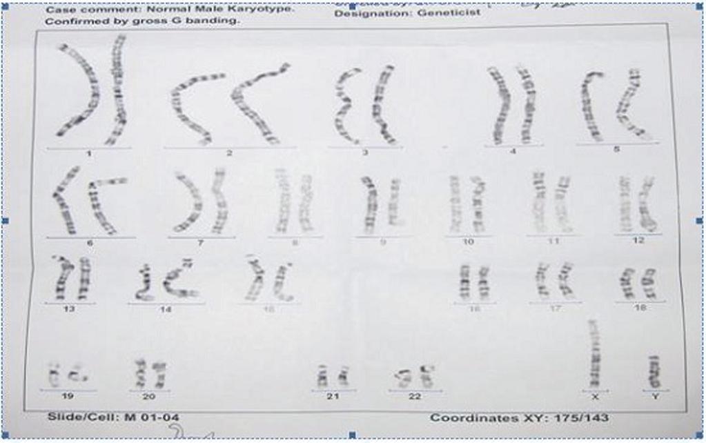 Figure 3 The patient s karyotype was that of a male