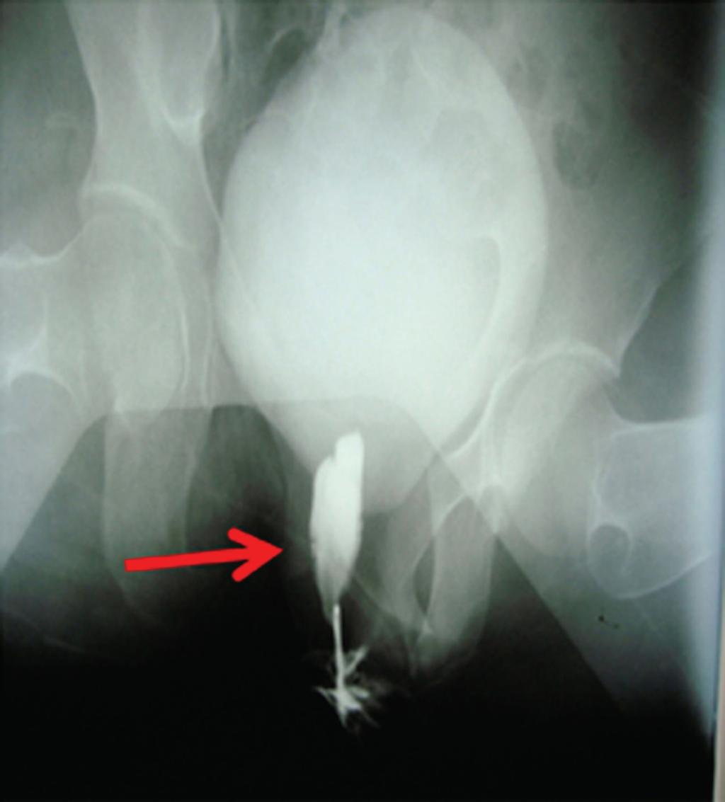 Figure 4 Genitogram showing blind-ending vaginal pouch measuring 4.5 cm. early, the condition may lead to death.