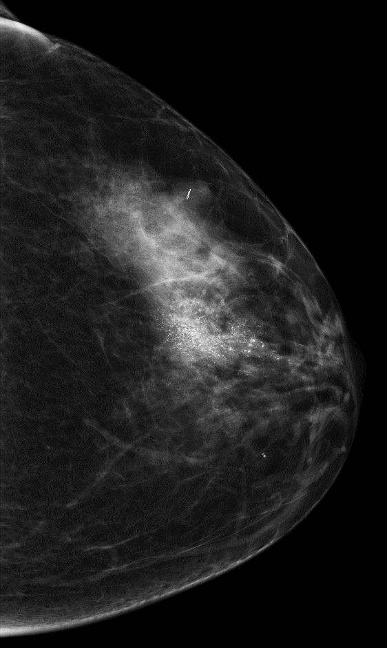 Screening Mammography Prior biopsied fibroadenoma Calcifications Prior biopsied