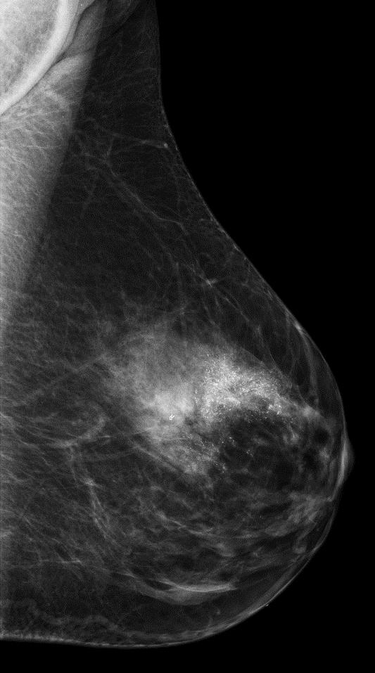 segmentally distributed microcalcifications in the left breast from 12-1 o clock.
