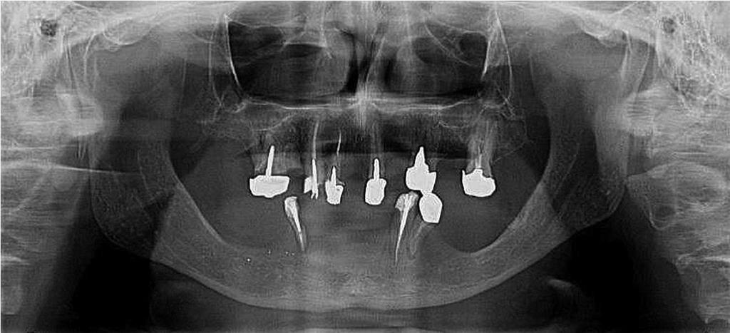 Augmentation and implant treatment Two-stage surgery in the severely resorbed edentulous mandible Author: Dr Marko Nikolic, Croatia Fig.